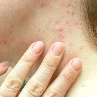 Primo caso di vaiolo delle scimmie in Canton Ticino