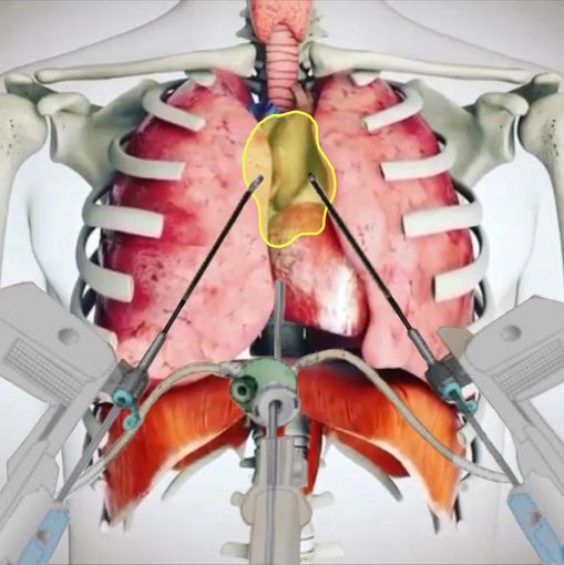 Intervento innovativo alle Molinette: salvato un uomo con una massa tumorale di 10x10 cm sopra il cuore Intervento innovativo alle Molinette: salvato un uomo con una massa tumorale di 10x10 cm sopra il cuore