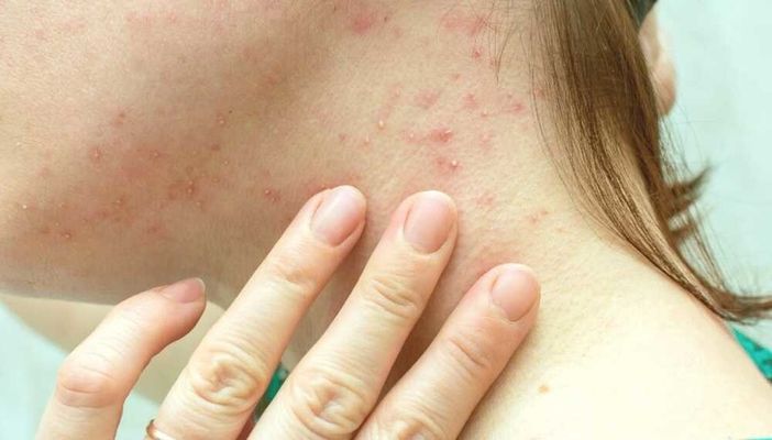 Primo caso di vaiolo delle scimmie in Canton Ticino Primo caso di vaiolo delle scimmie in Canton Ticino