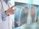 Tumori, nel 2050 i morti cancro supereranno i 18 milioni (+75%): lo studio su Lancet