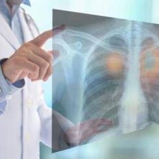 Tumori, nel 2050 i morti cancro supereranno i 18 milioni (+75%): lo studio su Lancet