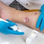 Idrosadenite suppurativa, le iniziative di Ucb per migliorare diagnosi e cura Idrosadenite suppurativa, le iniziative di Ucb per migliorare diagnosi e cura