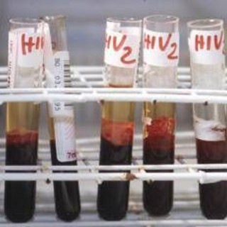 Aids, scoperti 'codici' del sistema immunitario per sospendere le cure