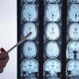 Di Battista e il tumore al cervello, in Italia circa 6mila diagnosi ogni anno: quali sono i sintomi 'spia' Di Battista e il tumore al cervello, in Italia circa 6mila diagnosi ogni anno: quali sono i sintomi 'spia'