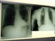 Salute, esperti: &quot;Virus sinciziale sottovalutato nonostante oltre 50mila ricoveri l'anno&quot;