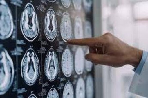 Stop tremori Parkinson senza bisturi, 10 pazienti curati con ultrasuoni a Napoli Stop tremori Parkinson senza bisturi, 10 pazienti curati con ultrasuoni a Napoli