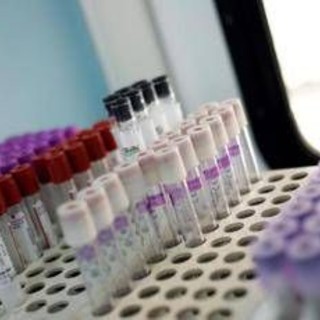 Mielofibrosi, speranze da nuovo farmaco che limita l'anemia in 2 pazienti su 3