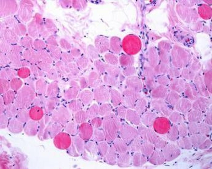 Malattie rare, risultati positivi a 5 anni per vamorolone in distrofia Duchenne Malattie rare, risultati positivi a 5 anni per vamorolone in distrofia Duchenne