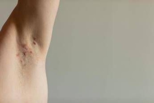 Idrosadenite suppurativa, appello esperti 'sia inserita nel Piano delle cronicità'