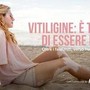 Salute, Giornata vitiligine: al via campagna 'Oltre falsi miti verso nuove possibilità'