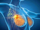 Cancro seno, con profilazione molecolare e terapie target migliori prospettive di cura