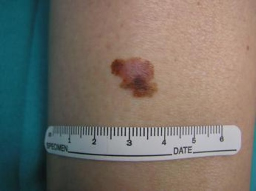 Cancro, oncologo: &quot;Tre anni per vaccino mRna contro melanoma&quot;