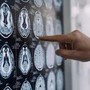 Centro Dbs Pavia, 100 interventi di neurostimolazione profonda per Parkinson Centro Dbs Pavia, 100 interventi di neurostimolazione profonda per Parkinson